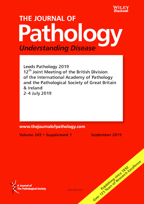 IgG4 Expression Correlates with Poor Prognosis in Pancreatic Adenocarcinoma Thumbnail