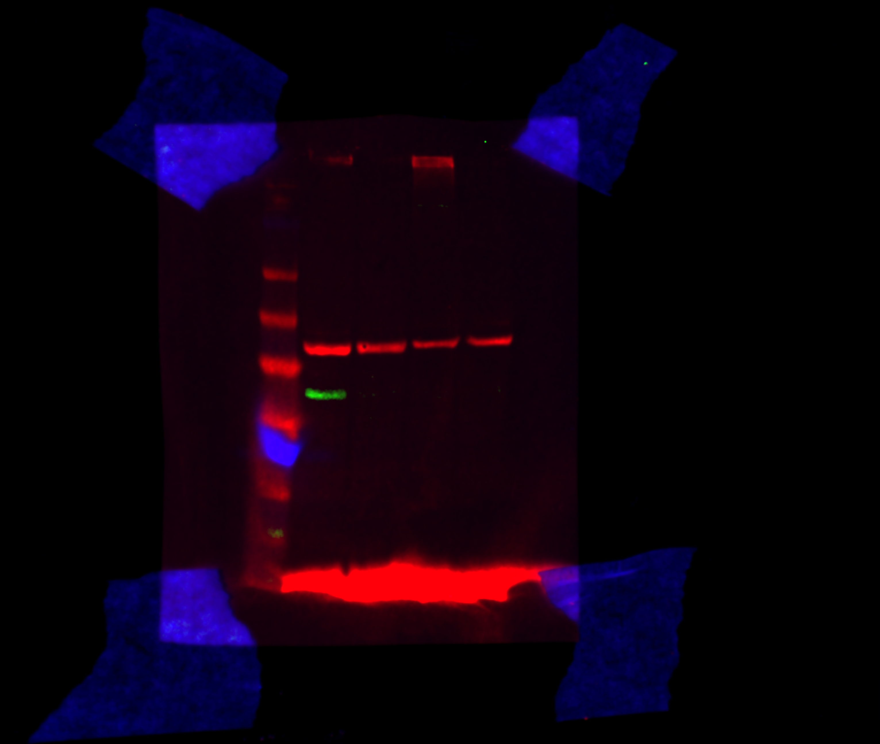 Unravelling transcriptomic complexity in breast cancer