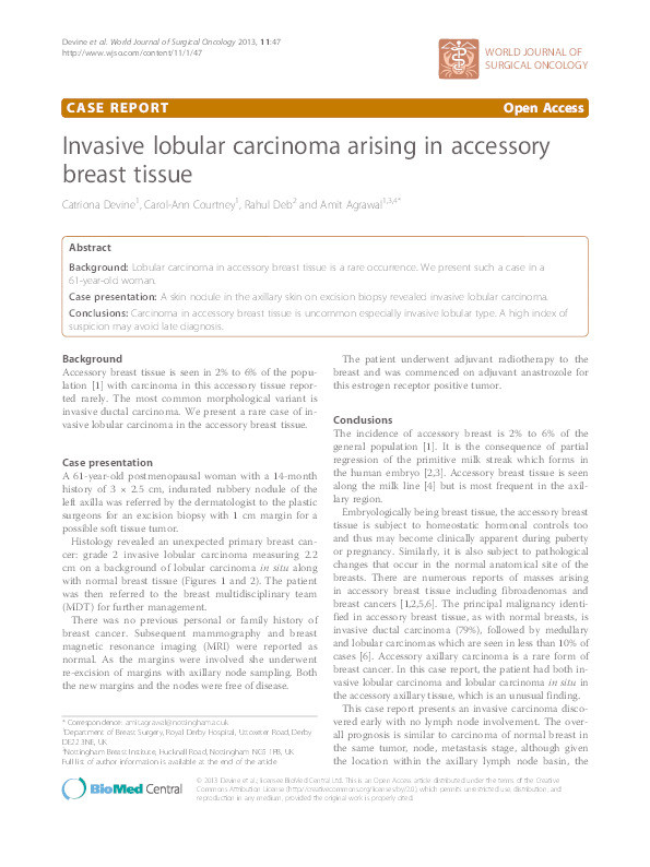 Invasive lobular carcinoma arising in accessory breast tissue Thumbnail